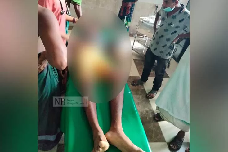 সাপের কামড়ে ঝাড়ফুঁক, পরে হাসপাতালে মৃত্যু 