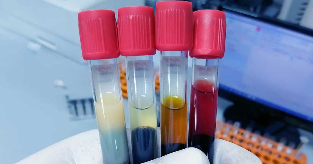 Jaundice-symptoms-and-necessary-tests-to-know
