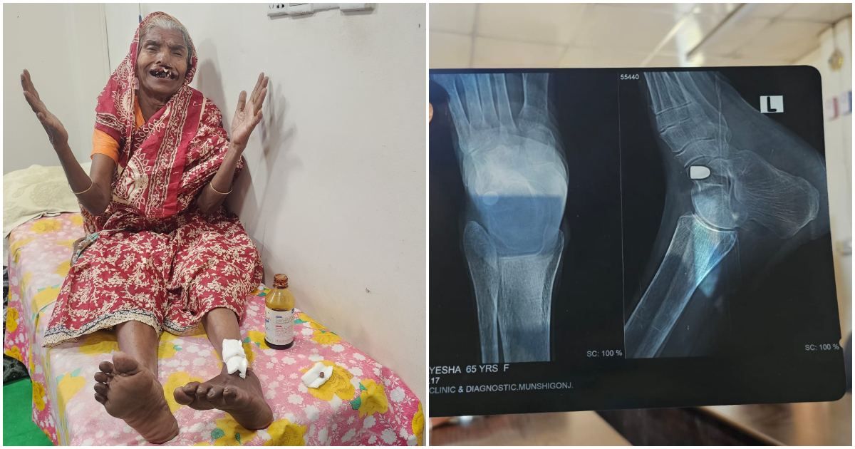 ৪-মাস-পর-বের-হলো-আন্দোলনে-আহত-ভিক্ষুকের-পায়ের-গুলি