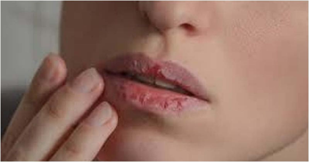 Cracked-lips-before-winter? 