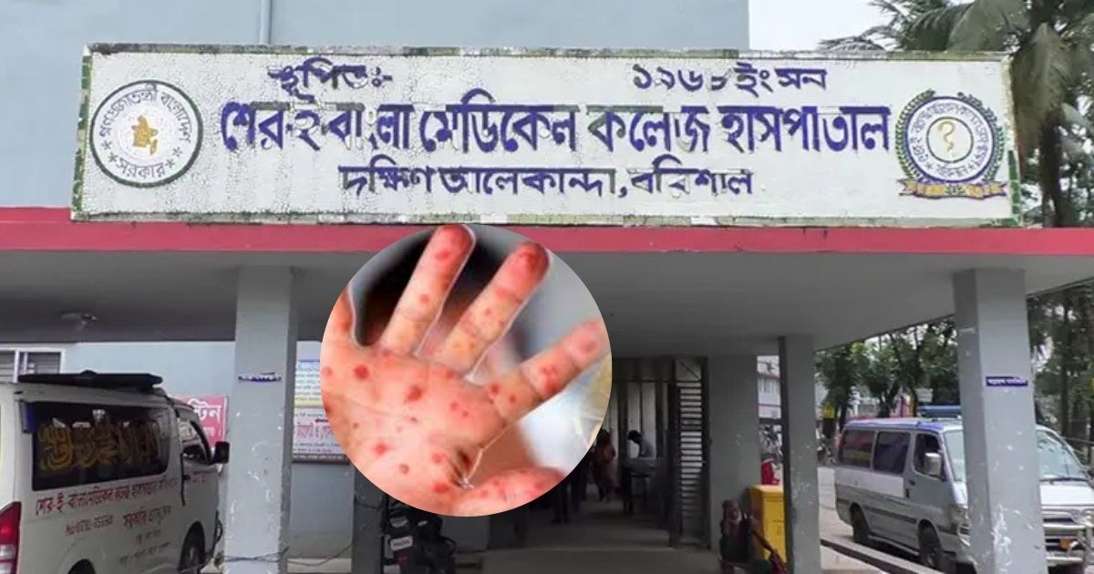 বরিশালে হাম উপসর্গে আরও ২ শিশুর মৃত্যু, মৃতের সংখ্যা বেড়ে ৩৬
