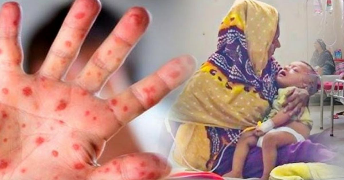 500-died-from-measles-and-symptoms