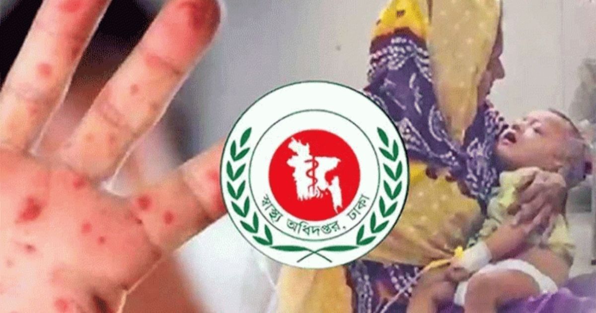 হামের উপসর্গে আরও ৫ শিশুর মৃত্যু, আক্রান্ত ৮৭৭
